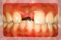 歯を1本喪失、他の歯は問題がない場合の治療_before
