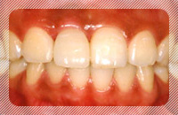 歯を1本喪失、他の歯は問題がない場合の治療_after