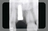 歯を1本喪失、他の歯は問題がない場合の治療_レントゲン写真_before