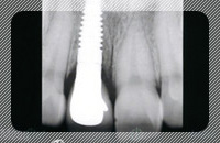 歯を1本喪失、他の歯は問題がない場合の治療_レントゲン写真_after