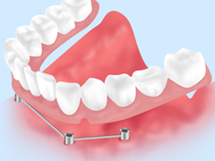 ［画像］複数の歯を失った場合のインプラント治療～インプラントオーバーデンチャー～