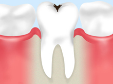 ［画像］虫歯と歯の喪失